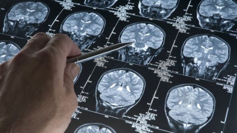 Main image for Below-average rise in dementia cases
