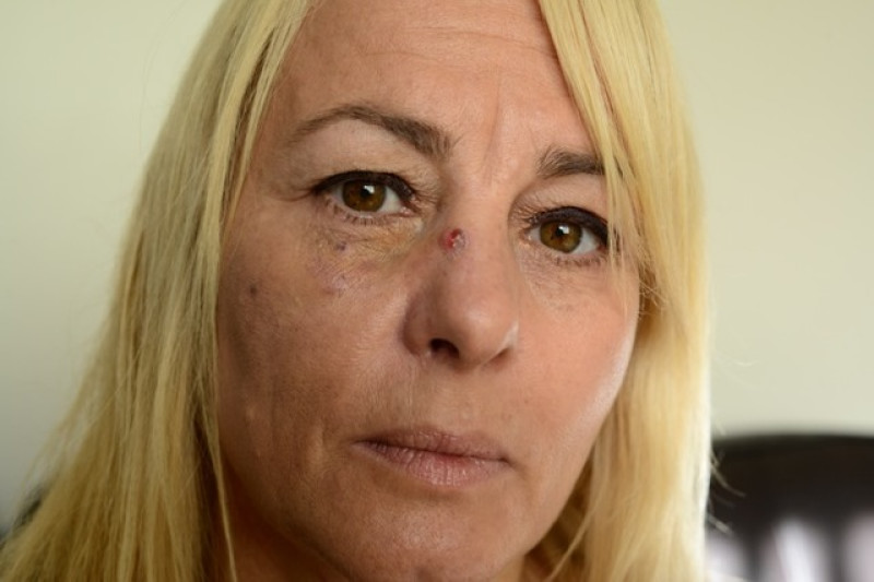 Main image for Woman struck by debris in bonfire accident