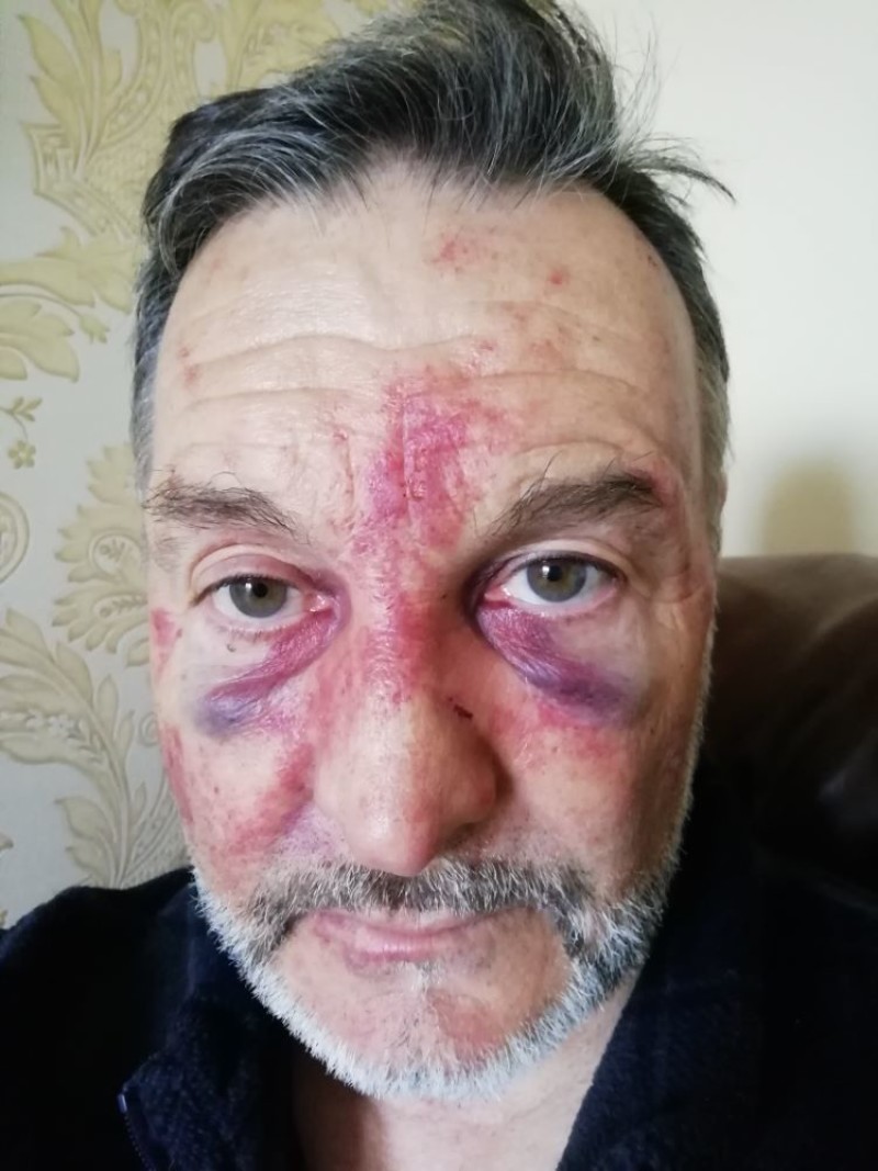 Main image for Ex-Red Ian is still on the mend from attack