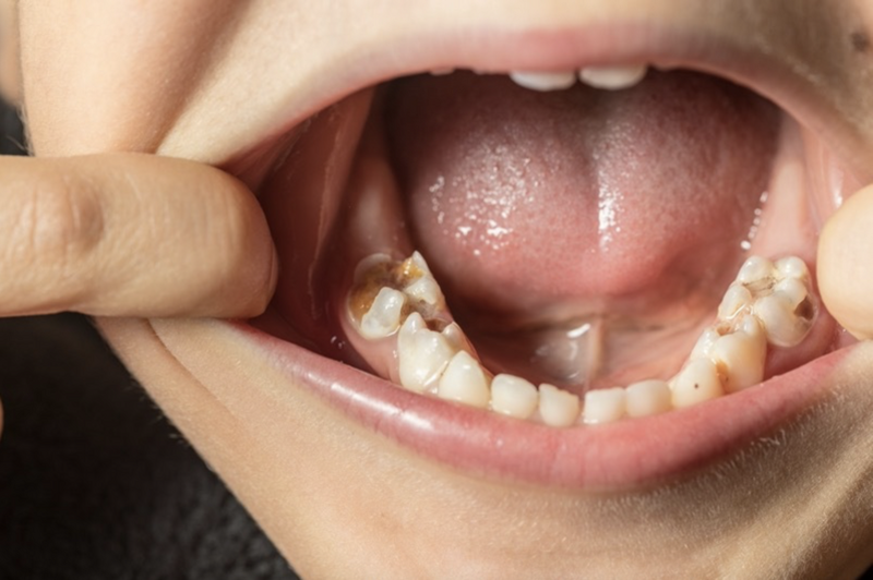 Main image for Tooth decay issues must be dealt with